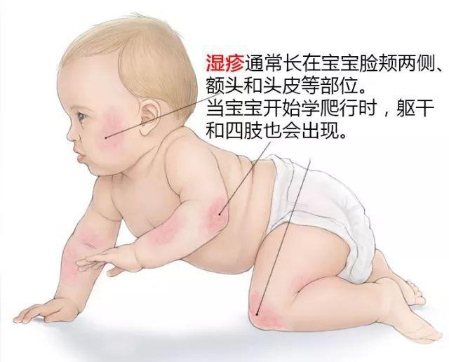 宝宝胎毒的症状图片图片